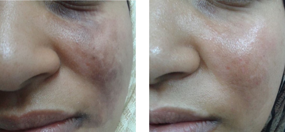 Radiance & Pigmentation Reset